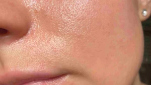 عکس نزدیک از صورت دختری که پوست چرب و پر از منافذ باز دارد