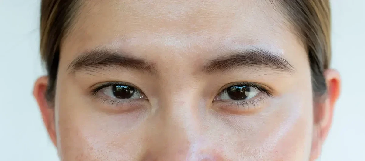 عکس نزدیک از صورت دختری که پوست چرب دارد
