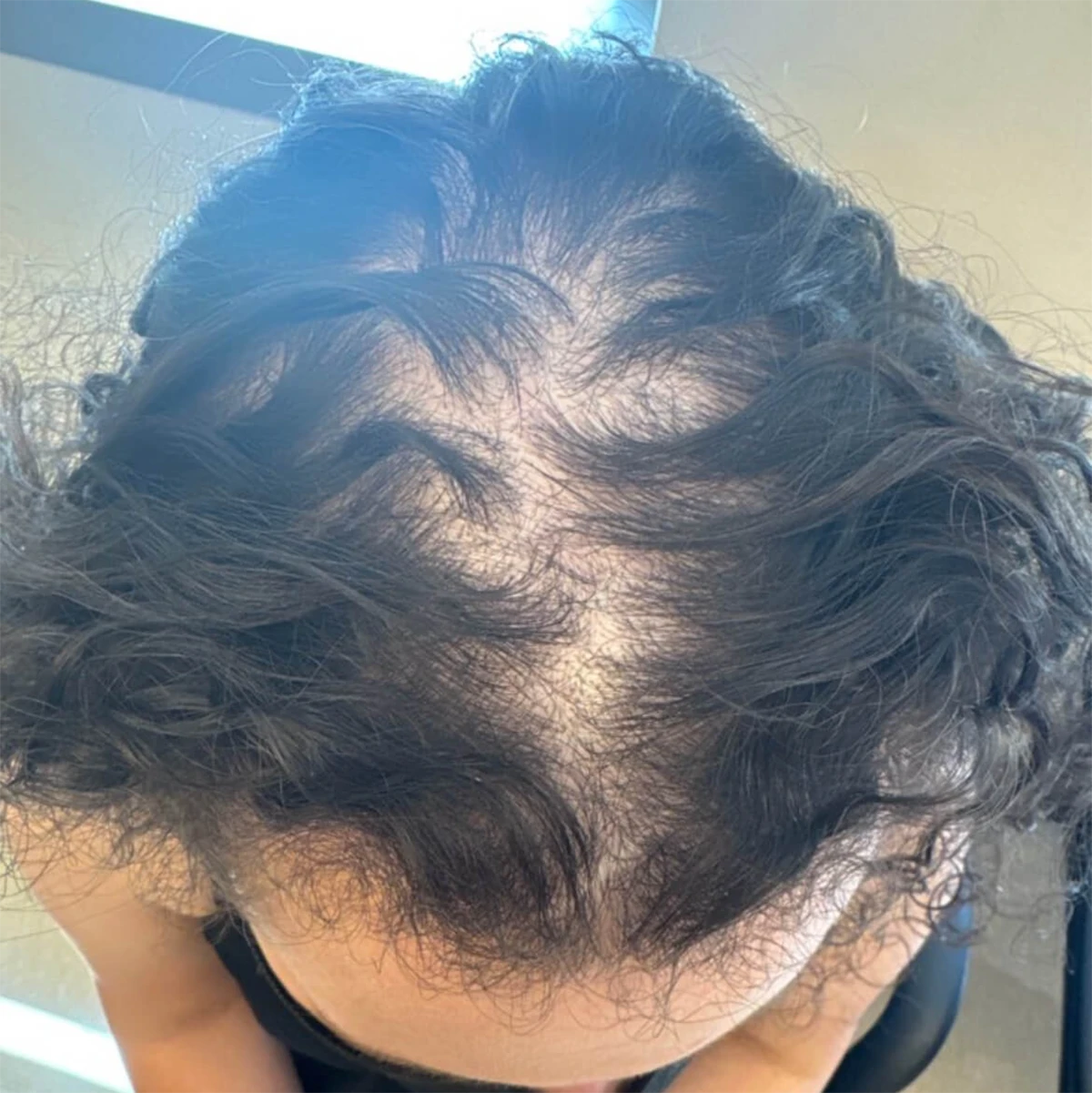 عکس از بالای سر دختری که موهای او کم پشت شده است